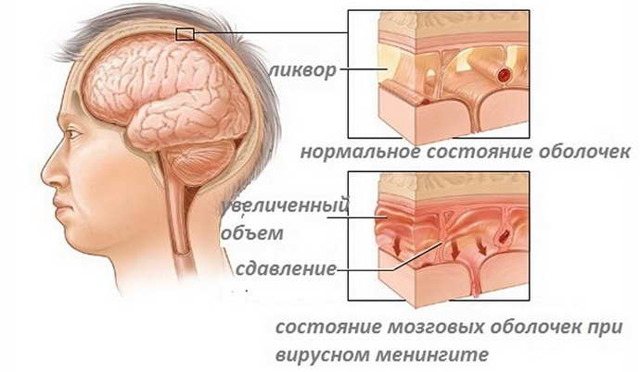 Кіста в голові у дорослого: симптоми і наслідки