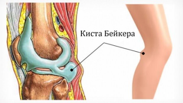 Симптоми і методи лікування кісти Бейкера колінного суглоба