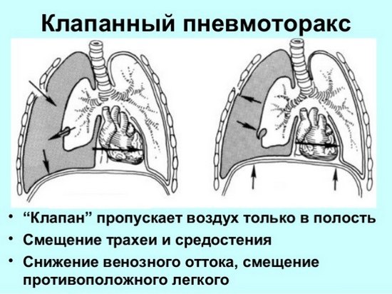 клапанний пневмоторакс