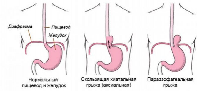 Класифікація гриж стравохідного отвору діафрагми