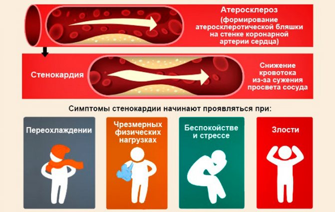 Класифікація нестабільної стенокардії по Браунвальду, симптоми і лікування