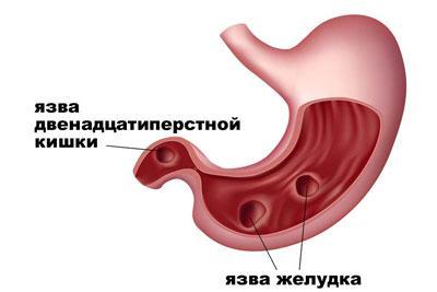 Препарат «Коделак бронхо»: склад, властивості і відгуки