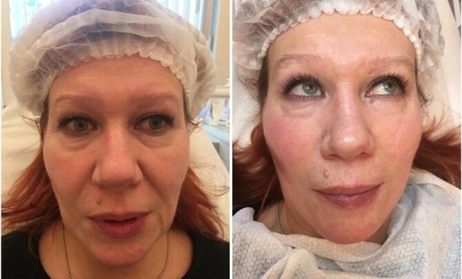 Як діє ботокс для особи – можливі негативні наслідки і фото до і після процедури