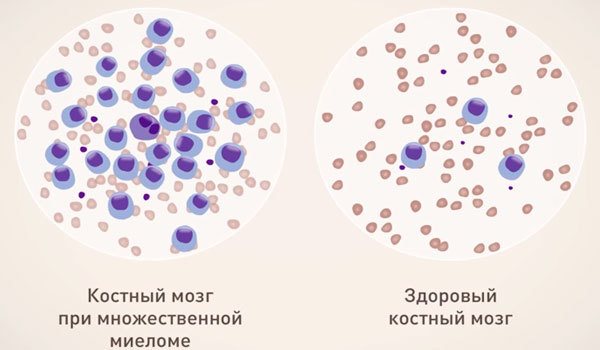 Кістковий мозок при мієломі