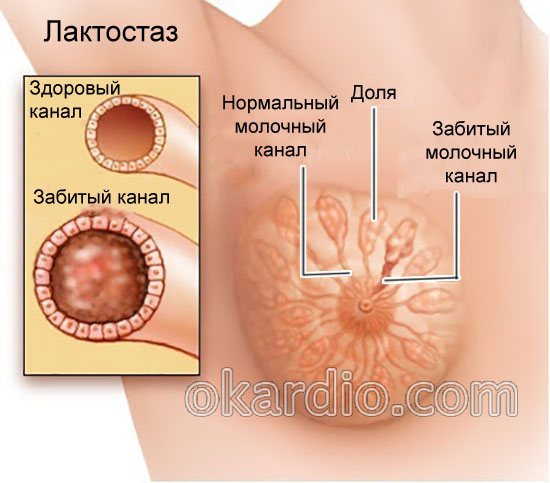 лактостаз