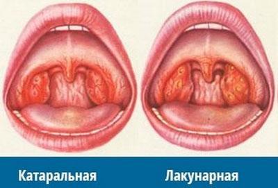 Лакунарна і катаральна ангіна