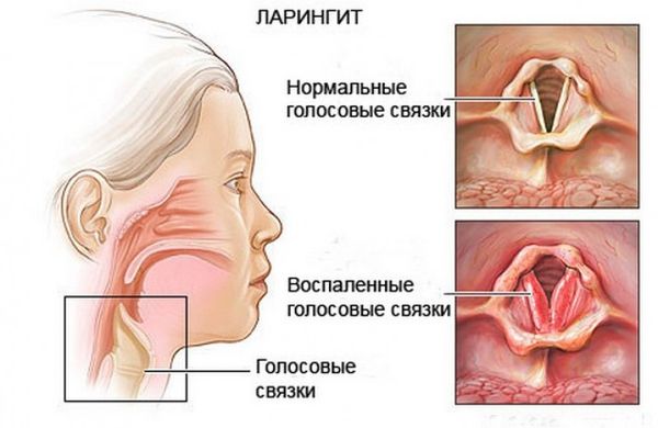 ларингіт