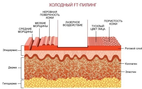 Лазерна шліфовка особи: фракційна, алмазна, СО2.  Відгуки, фото, ціна процедури в салоні і як зробити в домашніх умовах