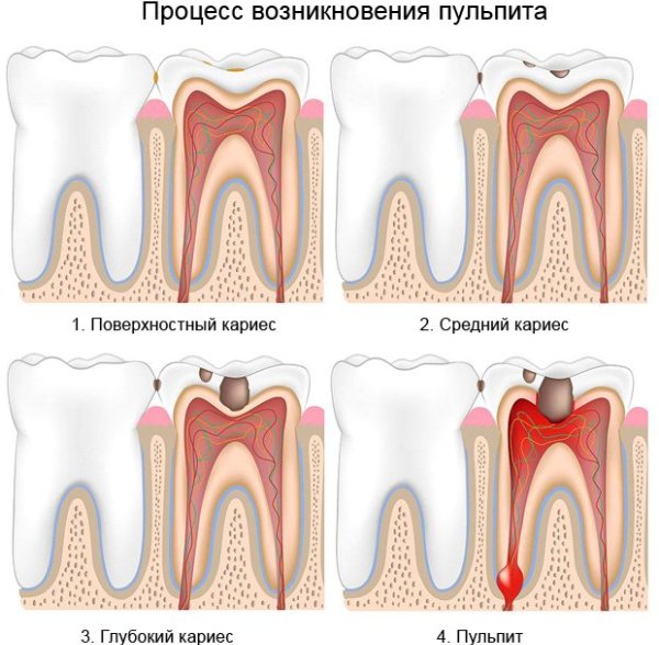 Лікування початкового пульпіту