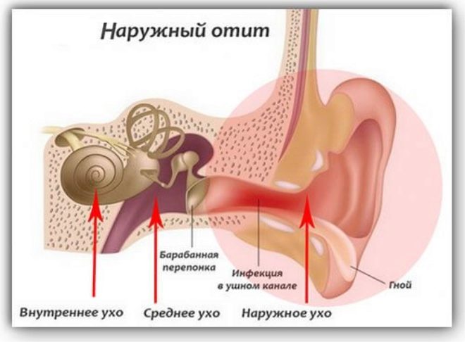 Лікування отиту у дітей основні види отиту і методи лікування