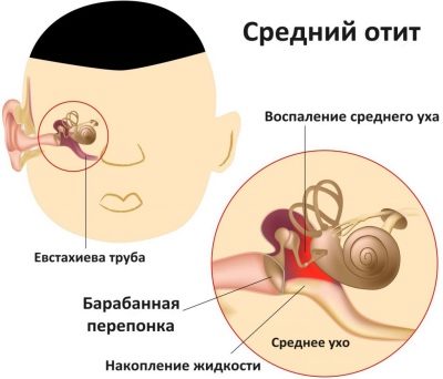 Лікування отиту у дітей основні види отиту і методи лікування