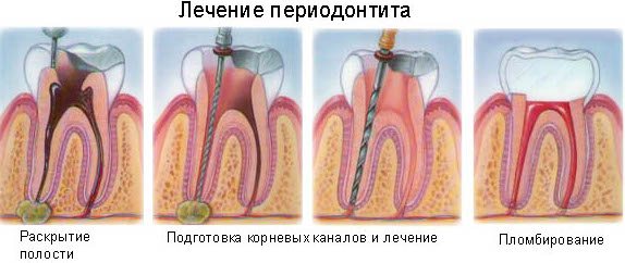 лікування періодонтиту