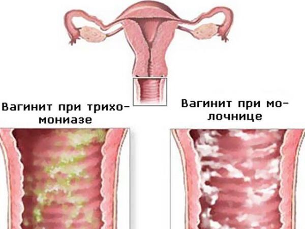 Лікування вагініту - бактеріальний, атрофічний, гострий, хронічний, неспецифічний, симптоми, препарати, свічки, при беременнос