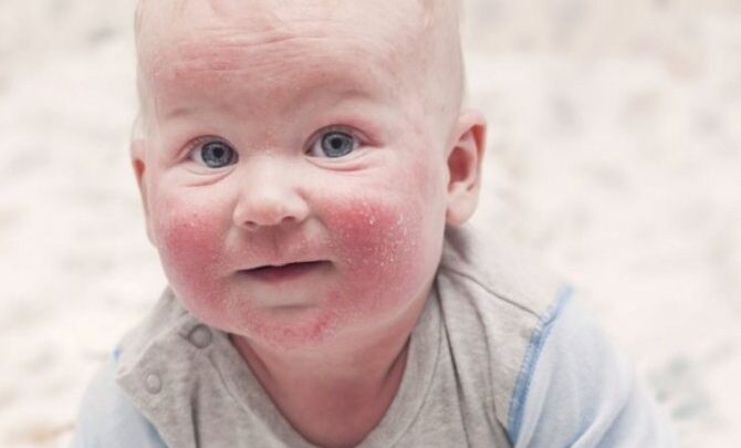 Що таке екзема – причини і лікування у дітей та дорослих