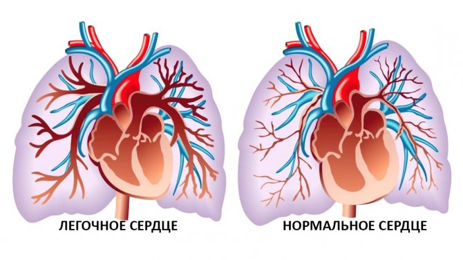 Легеневе серце причини