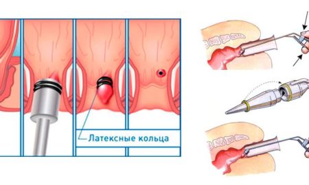 лігування латексними кільцями