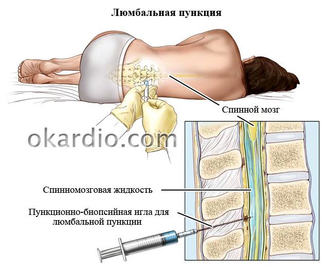 люмбальна пункція