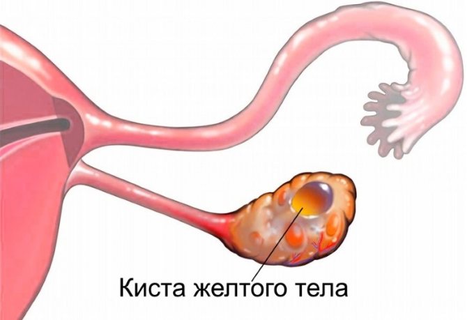 лютеиновая кіста