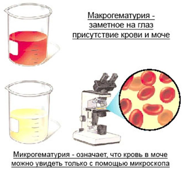 Макрогематурия, мікрогематурія