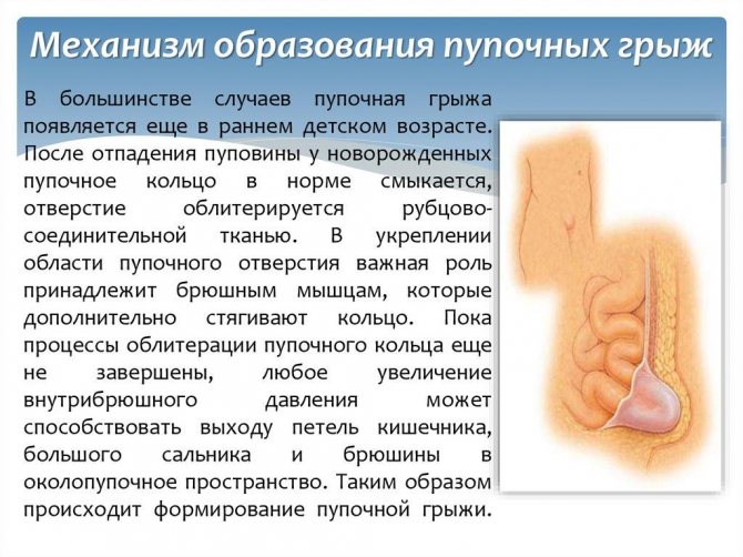 Механізм утворення пупкової грижі