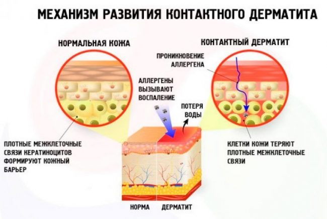 Механізм розвитку контактного дерматиту