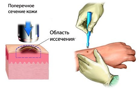 Чотири стадії меланоми – Клініка діагностики та лікування онкології