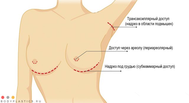 методи маммопластики