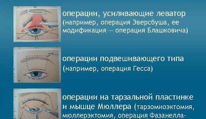 Птоз верхньої повіки: які ж причини його викликають і як боротися?