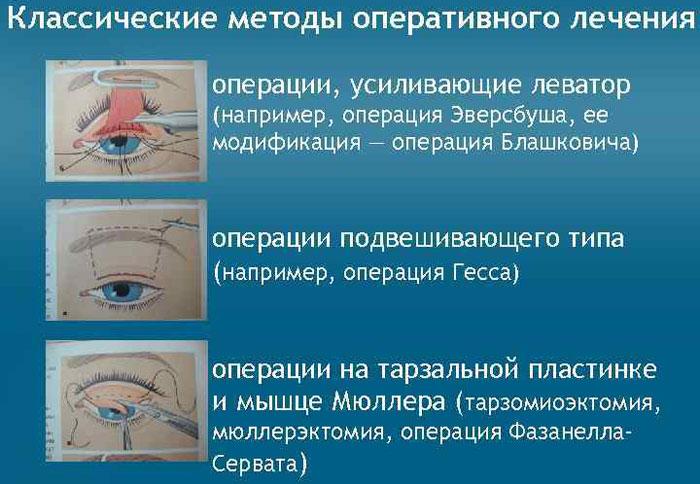 Птоз верхньої повіки: які ж причини його викликають і як боротися?