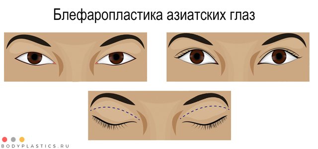 Методи проведення блефаропластики азіатських століття