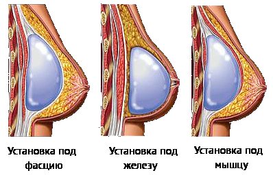 Методи установки грудних імплантів