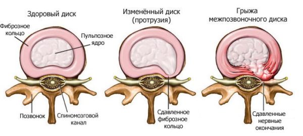 Міжхребцева грижа