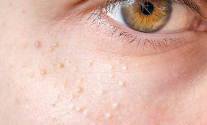 Як можна прибрати жир з лиця, щік і підборіддя в домашніх умовах?