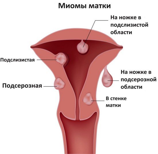 Міоми в матці можуть стати причиною маткової кровотечі