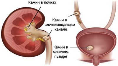 Мочекам'яна хвороба