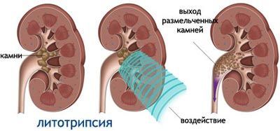 Мочекам'яна хвороба