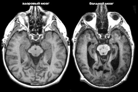 мозок людини з Альцгеймером
