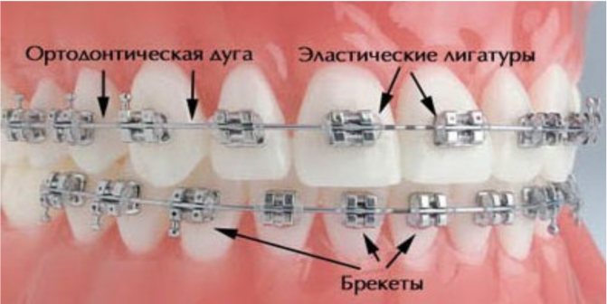 чи можна робити рентген в брекетах