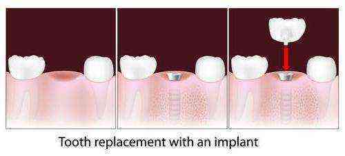 чи можна замінити всі зуби на імпланти