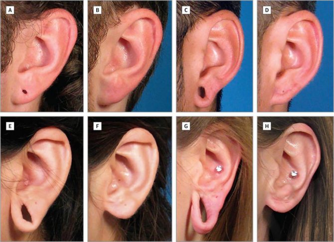 Як швидко можуть зарости дірки у вухах?