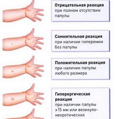 До 7 років – проба Манту, потім – Діаскінтест. Це наказ