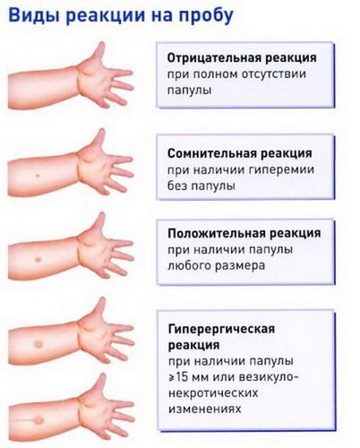 До 7 років – проба Манту, потім – Діаскінтест. Це наказ