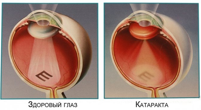 Початкова катаракта очі: причини, симптоми, ефективне лікування ранньої стадії, профілактика, що робити