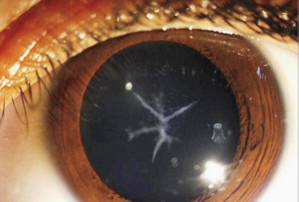 Катаракта. Причини, симптоми, лікування і профілактика. Народні засоби, операція