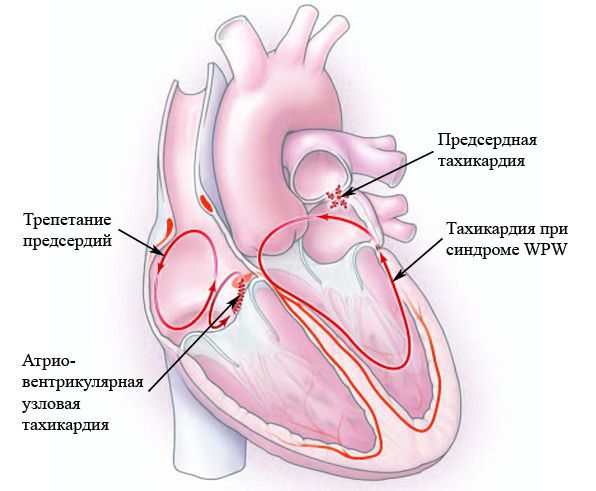 надшлуночкові тахікардії