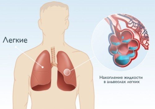 Накопичення рідини в альвеолах легких