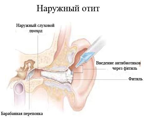 Зовнішній отит у дорослих і дітей – причини виникнення, симптоми, діагностика та засоби лікування