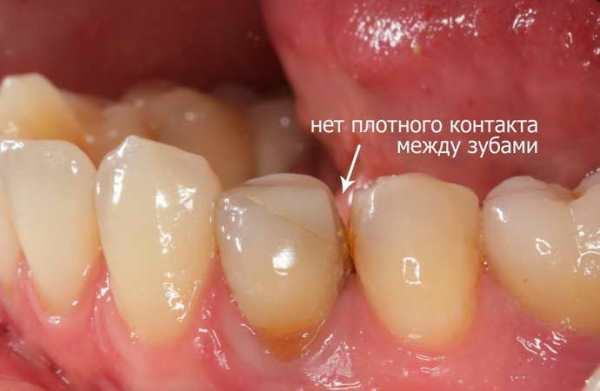 Неприємний запах з під коронки зуба причини