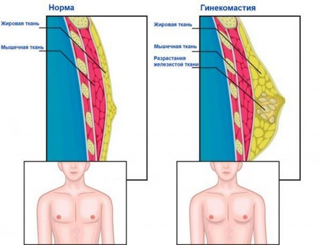 Нормальна грудна залоза і гінекомастія