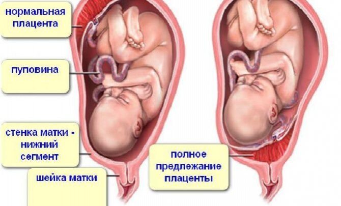 Про передлежанні плаценти при вагітності: що це таке, чим небезпечне, як лікувати?